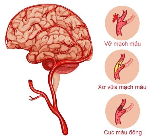 cac-nguyen-nhan-khong-ngo-khien-ban-de-mac-phai-dot-quy-1.jpg